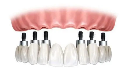 Протези зъби в отсъствие - Методи за протеза на edentulous