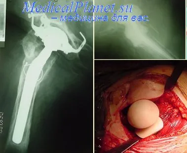 rehabilitáció osteomyelitis