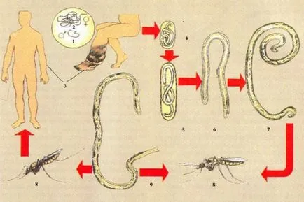 Filariaza - cauze, simptome, simptome și tratament