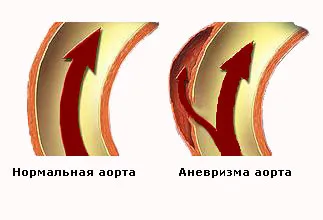 Disecant anevrism aortic - Simptome, Diagnostic si Tratament