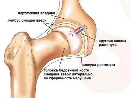 Унищожаването на тазобедрената става причините и лечението