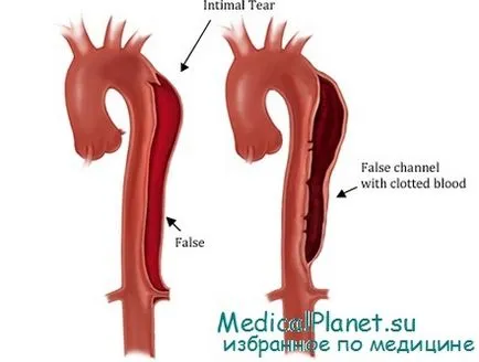 Boncoló aorta aneurizma - klinikai kép, diagnózis