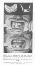 Възстановяване и реконструкция на протези, зъбни протези