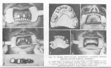 Възстановяване и реконструкция на протези, зъбни протези