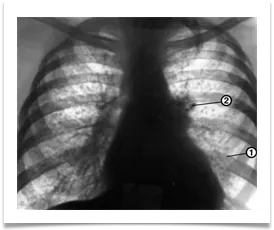 X-ray diagnózis tuberkulózis