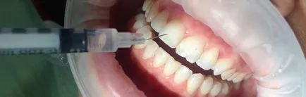 recesiune gingivală și de mase plastice în stomatologie