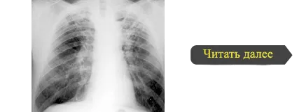 X-ray diagnózis tuberkulózis