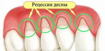 recesiune gingivală și de mase plastice în stomatologie