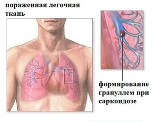 Sarcoidosis - okai, tünetei, tünetek és kezelés