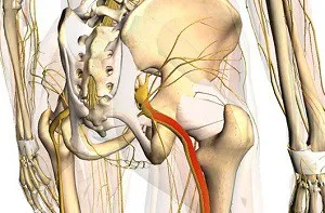 Симптоми и лечение на заболявания на седалищния нерв