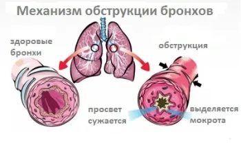 Симптомите на обструктивен бронхит при деца и неговата схема на лечение