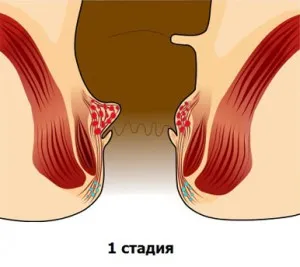 Hemoroizii Step - 1, 2, 3, 4, hemoroizi pas