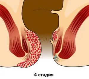 Стъпка хемороиди - 1, 2, 3, 4, хемороиди стъпка