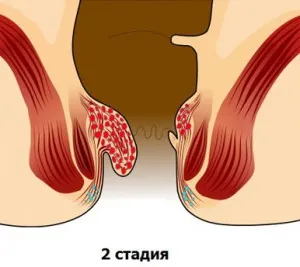 Hemoroizii Step - 1, 2, 3, 4, hemoroizi pas