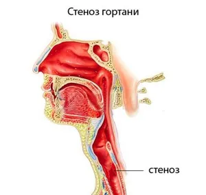 Стеноза на ларинкса предизвиква симптомите на детето и за възрастни, лечение