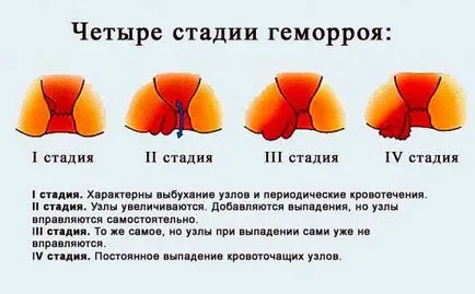 Стъпка хемороиди - 1, 2, 3, 4, хемороиди стъпка