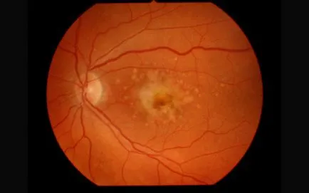 Субретинални кръвоизлив, диагностика и лечение на очите (снимка)