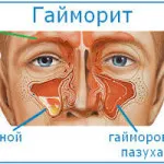 remedii populare de tratament Sinuzita și tehnici de la domiciliu