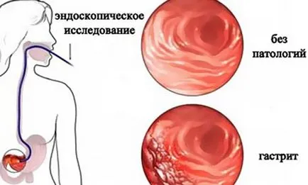 Гастрит лечение на симптомите - причинява гастрит и как да се лекува