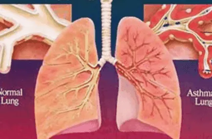 астма атопичен, алергичен, кашлица