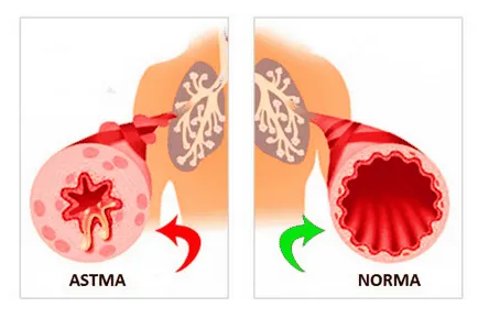 astm atopic, alergic, tuse