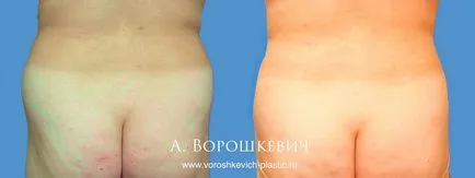 Tumescent zsírleszívás Moszkvában