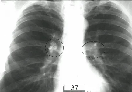 Bronhoadenit tuberkulózis tünetei gyermekekben