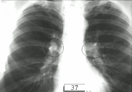 Simptomele tuberculozei Bronhoadenit la copii