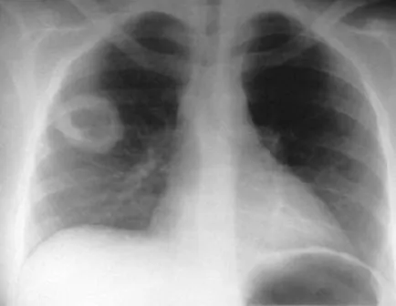 Tuberculoza este pe raze X - specie și de modul de a determina cursul procedurii