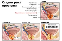 уголемени симптоми на простатата, причини, лечение