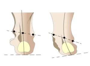 Valgus деформация на лечението крак, стелка, снимки