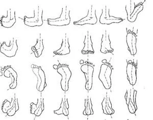 Valgus деформация на лечението крак, стелка, снимки