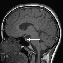 Tipuri de tumori cerebrale și specii de clasificare