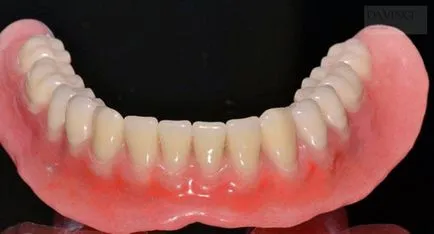 Restaurarea dinților cu edentație complet