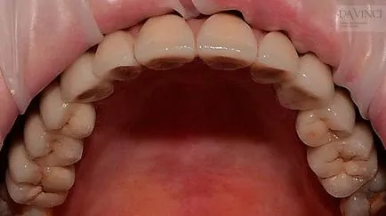 Възстановяване на зъби с напълно edentulous