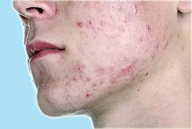 Acne vulgaris okai és kezelése