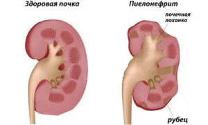 Homeopátia vese gyógyszerek, kezelés, vagy ártalom