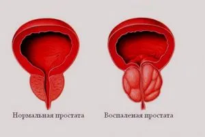 Херпесна простатит причини и лечение