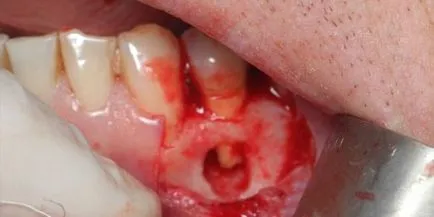 Гной от венците зъба около - лечение медицина и народни средства за защита