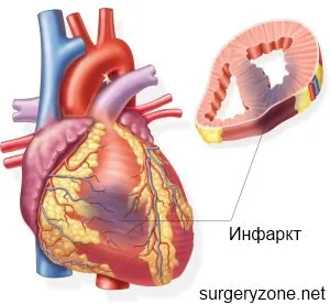 хроничен миокарден