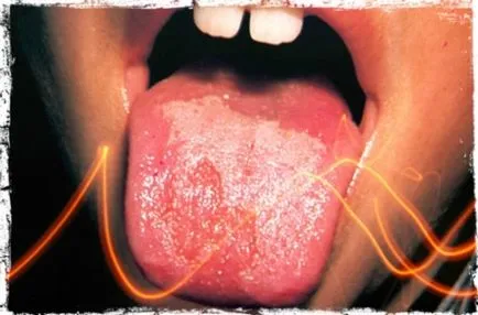 Ulcerele pe limba copilului