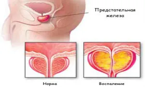 prostatita stagnantă la barbati cauze, simptome și tratament