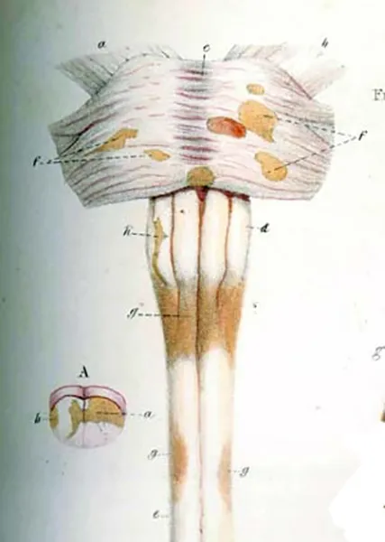 10 Fapte de scleroza multipla - de neuron