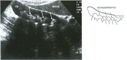 Allsurgery - krónikus calculous cholecystitis