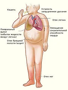 Ascites kezelés otthon