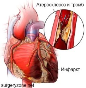 szív atherosclerosis