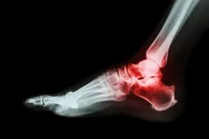 Boka arthritis reaktív, poszt-traumatikus, rheumatoid