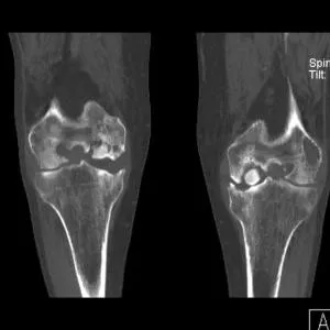 Koenig-kór (osteochondritis dissecans) okai, tünetei és kezelése