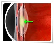 Celamig Гоз Lazer kliniği