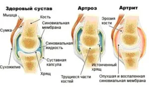 Какво е различен от артрит, остеоартрит симптоми, диагноза